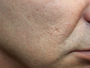 Fractional Laser Therapy Vancouver- Acne Scars (Before)