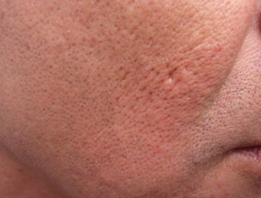 fractional-laser-treatment-acne-scars-before