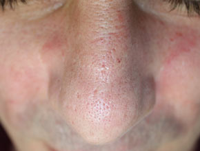 Fractional Laser Therapy Vancouver- Scar Removal (after)