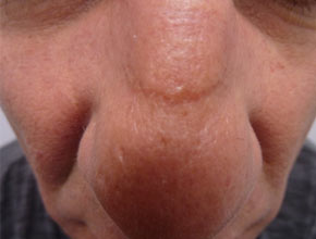 Fractional Laser Therapy Vancouver- Scar Removal (before)