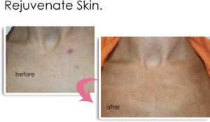 Rejuvenate Skin Vancouver