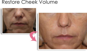 Dermal Fillers Vancouver