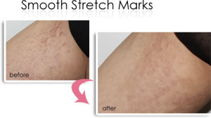 Smooth Stretch Marks Vancouver