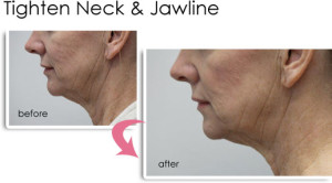 Skin Tightening Vancouver