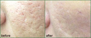 acne scar treatment
