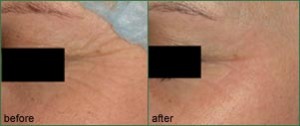 Crows Feet Removal Vancouver