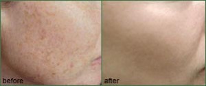 Freckle Removal Vancouver