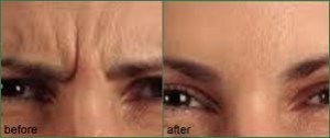 frown lines removal vancouver