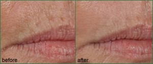 lip lines treatment