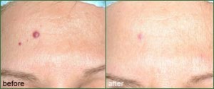 vascular lesion removal vancouver