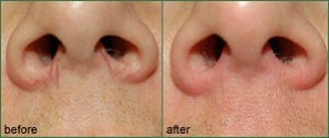 Vascular Lesion Treatment Vancouver