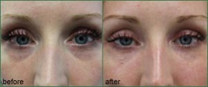 volume loss treatment vancouver
