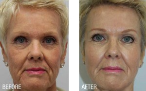 Before and After Botox Xeomin Vancouver