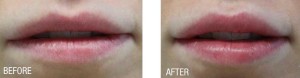 lip enhancement treatment vancouver